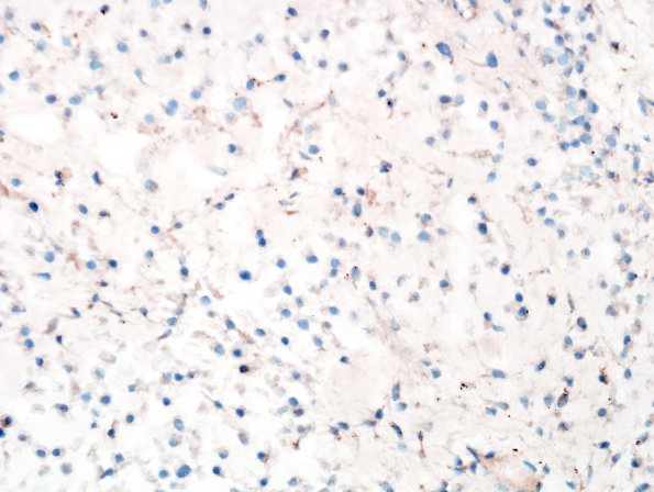 16C Chondrosarcoma, low grade (looks like chordoma, Case 16) Brachyury 1