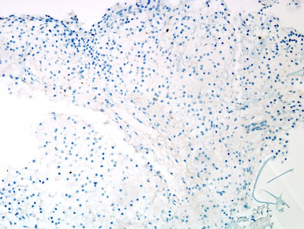 16D Chondrosarcoma, low grade (looks like chordoma, Case 16) CK 1