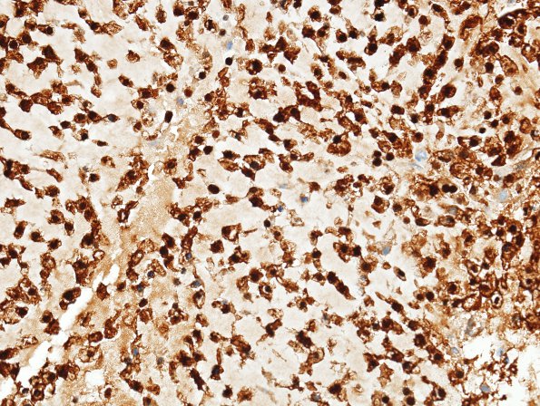 16E2 Chondrosarcoma, low grade (looks like chordoma, Case 16) S100 1