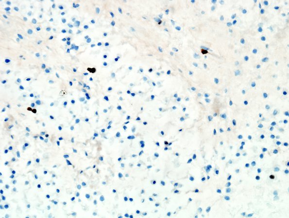 16F Chondrosarcoma, low grade (looks like chordoma, Case 16) Ki67 1