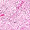 17A Chordoma (Case 17) H&E 10X - Copy (3)