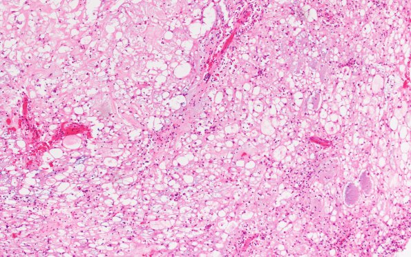 17A Chordoma (Case 17) H&E 10X - Copy (3)