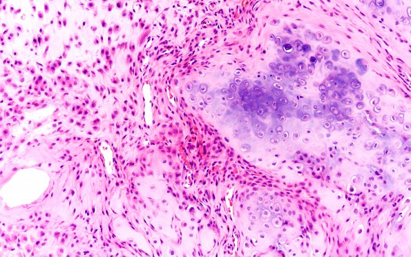 18A1 Chordoid chordoma (Case 18) H&E 20X 2