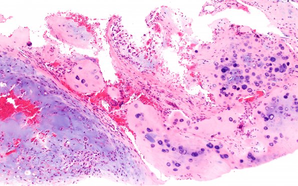 18A2 Chordoid chordoma (Case 18) H&E 20X junction