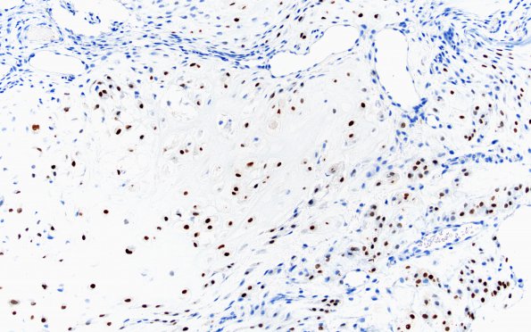 18B1 Chordoid chordoma (Case 18) Brachyury 20X 2