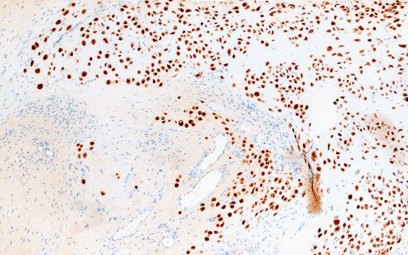 18B2 Chordoid chordoma (Case 18) Brachyury 10X 3