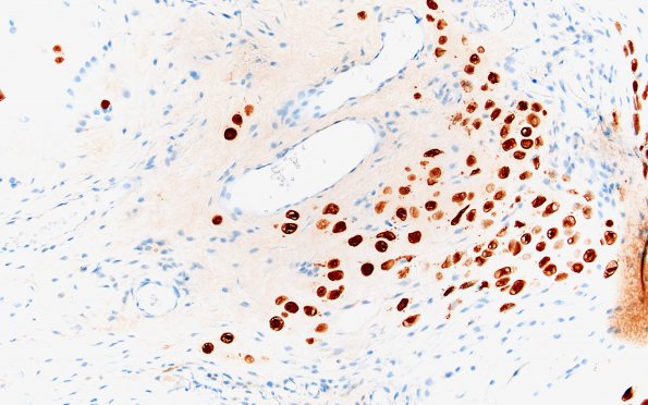 18B3 Chordoid chordoma (Case 18) Brachyury 20X 3