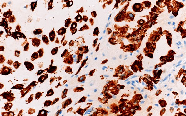 18C Chordoid chordoma (Case 18) CK 40X junction