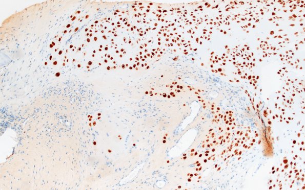 18D1 Chordoid chordoma (Case 18) S100 cartilage area 10X