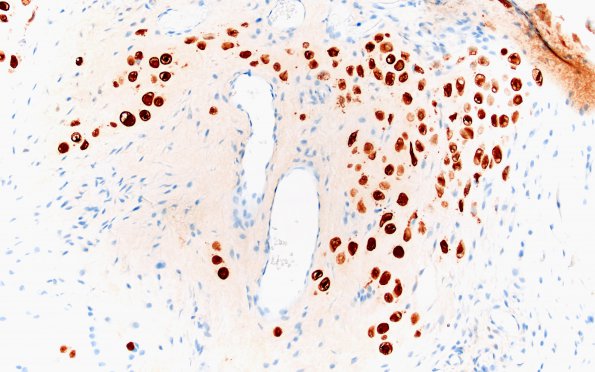 18D2  Chordoid chordoma (Case 18) S100 cartilage area