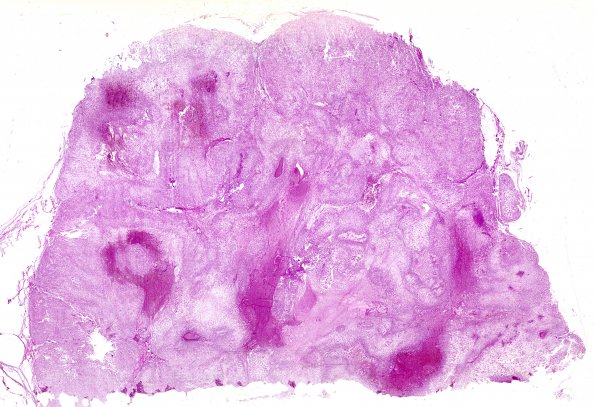 19A1 Chordoma, clivus (AFIP TS M9665 set Slide # 83, RES image) H&E whole mount