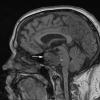 1A1 Chordoma (Case 1) T1 no C - Copy copy