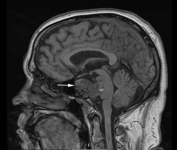 1A1 Chordoma (Case 1) T1 no C - Copy copy