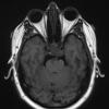 1A2 Chordoma (Case 1) T1 no C 2 - Copy