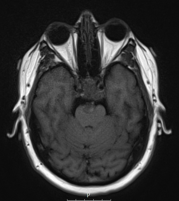 1A2 Chordoma (Case 1) T1 no C 2 - Copy