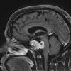 1A3 Chordoma (Case 1) T1 with C 5 - Copy