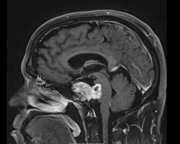 1A3 Chordoma (Case 1) T1 with C 5 - Copy