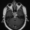 1A4 Chordoma (Case 1) T1 with C 3 - Copy