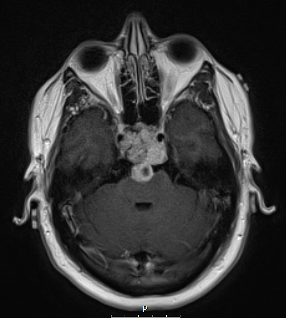 1A4 Chordoma (Case 1) T1 with C 3 - Copy