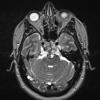 1A5 Chordoma (Case 1) T2 no C 2 - Copy