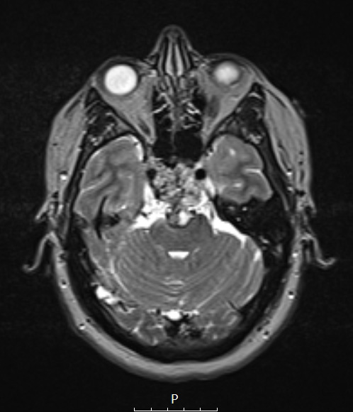 1A5 Chordoma (Case 1) T2 no C 2 - Copy