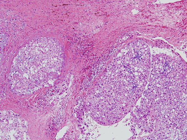 1B1 Chordoma (Case 1) H&E 3.jpg