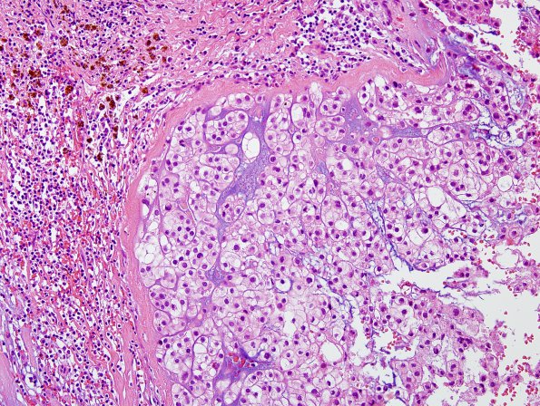 1B2 Chordoma (Case 1) H&E 5.jpg