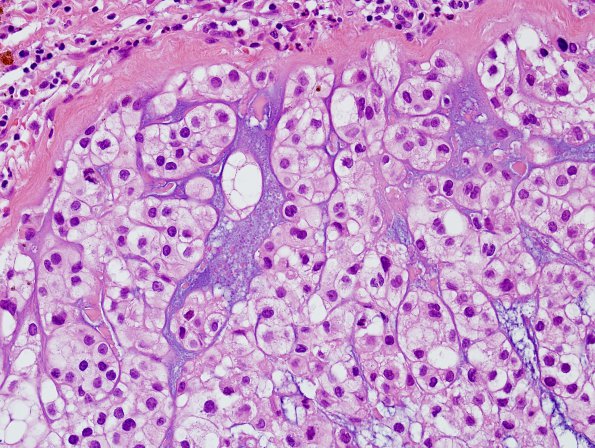 1B3 Chordoma (Case 1) H&E 4.jpg