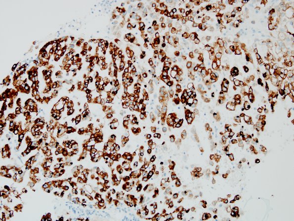 1D Chordoma (Case 1) EMA 1.jpg