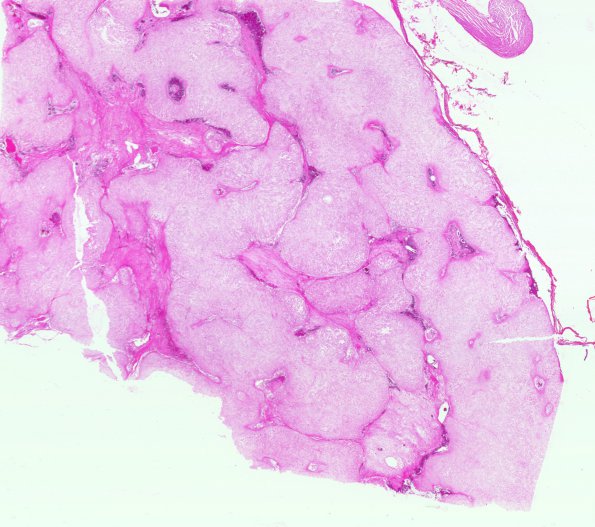 20A1 Chordoma, teaching set