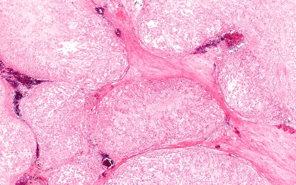 20A2 Chordoma, teaching set H&E 4X