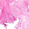 21A1 Chordoma (Case 21) 4X spindle cell area H&E copy