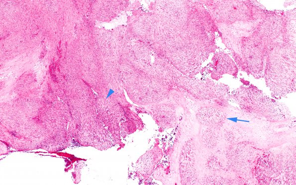 21A1 Chordoma (Case 21) 4X spindle cell area H&E copy