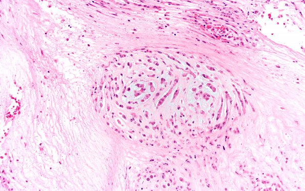 21A2 Chordoma (Case 21) 4X chordoma area H&E 20X