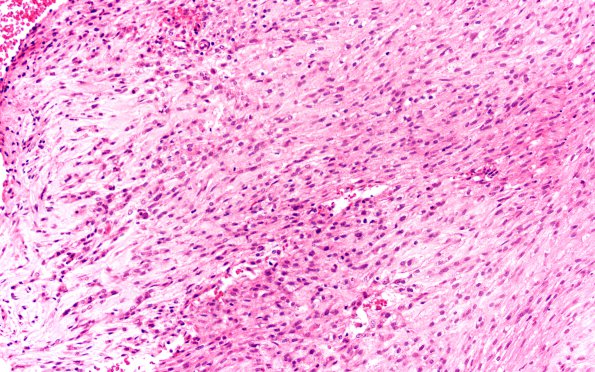 21A3 Chordoma (Case 21) 4X spindle cell area H&E 20X