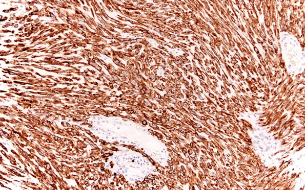 21C2 Chordoma (Case 21) spindle area CK 20X