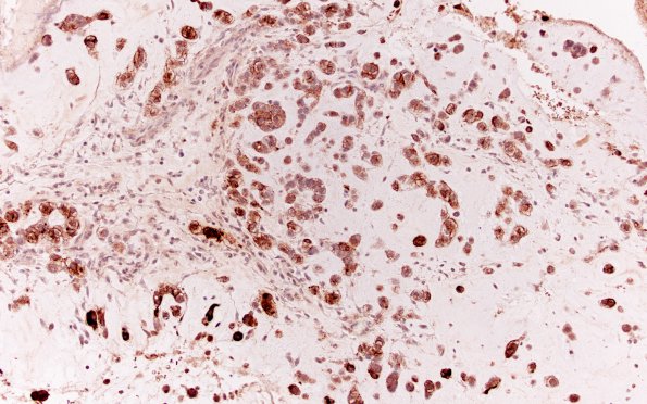 21D1 Chordoma (Case 21) 4X Chordomal area EMA 20X