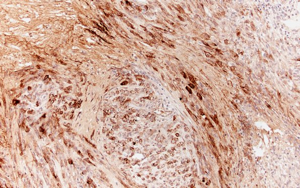 21D2 Chordoma (Case 21) spindle area EMA 20X