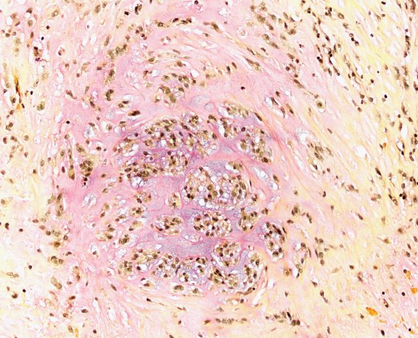 21F Chordoma (Case 21) Mucin 20X