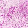 21G Chordoma (Case 21) PAS no diastase (glycogen) 20X 2