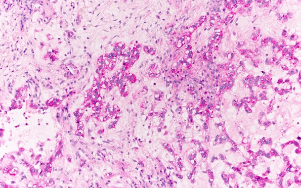 21G Chordoma (Case 21) PAS no diastase (glycogen) 20X 2