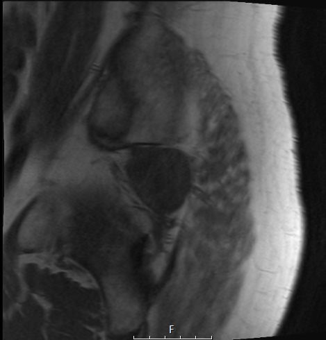 2A1 Chordoma (Case 2) T1 no C - Copy