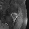 2A2 Chordoma (Case 2) T1 with C - Copy