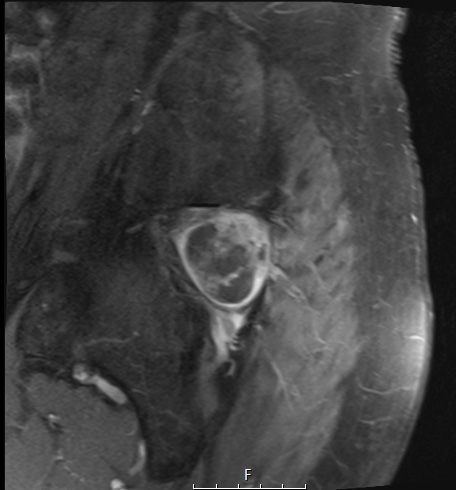 2A2 Chordoma (Case 2) T1 with C - Copy