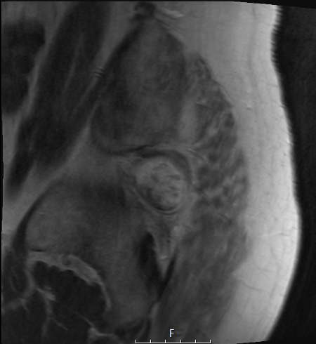 2A3 Chordoma (Case 2) T2 no C - Copy