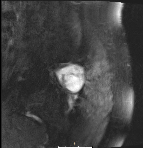 2A4 Chordoma (Case 2) T2 with C - Copy