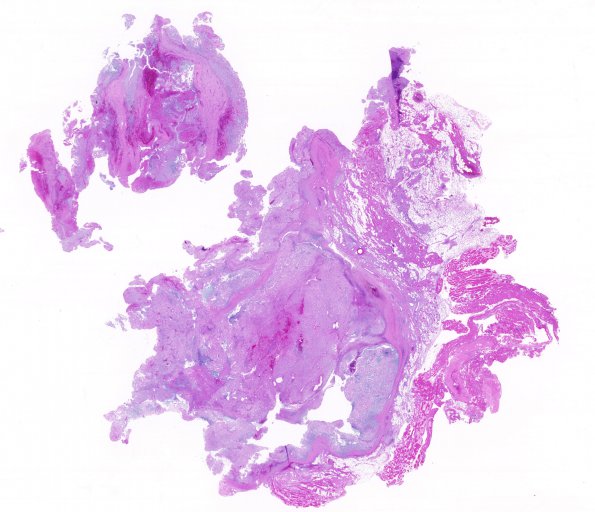 2B1 Chordoma, pelvic (Case 2) 1 H&E whole mount 1