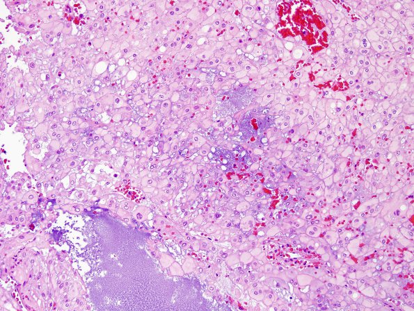 2B2 Chordoma, pelvic (Case 2) H&E 5.jpg