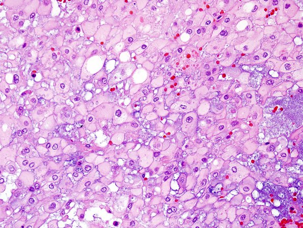 2B3 Chordoma, pelvic (Case 2) H&E 6.jpg