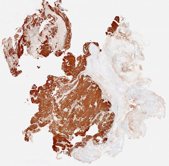 2E1 Chordoma, pelvic (Case 2) 1 CK whole mount